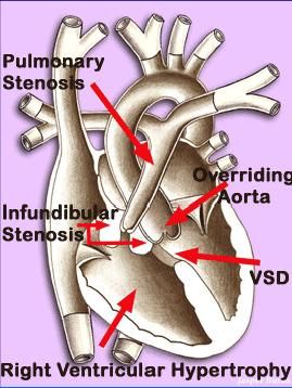 Heart defects in Downs