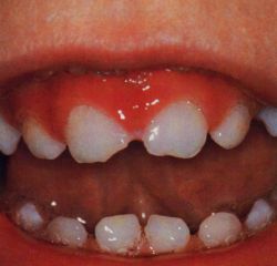 Tooth deformities in Downs