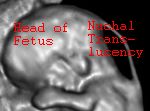 Nuchal Translucency