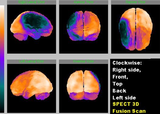 Brain SPECT in CP