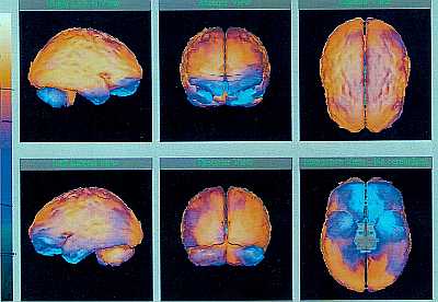 CT Spect Fusion Scan of Brain in ASD